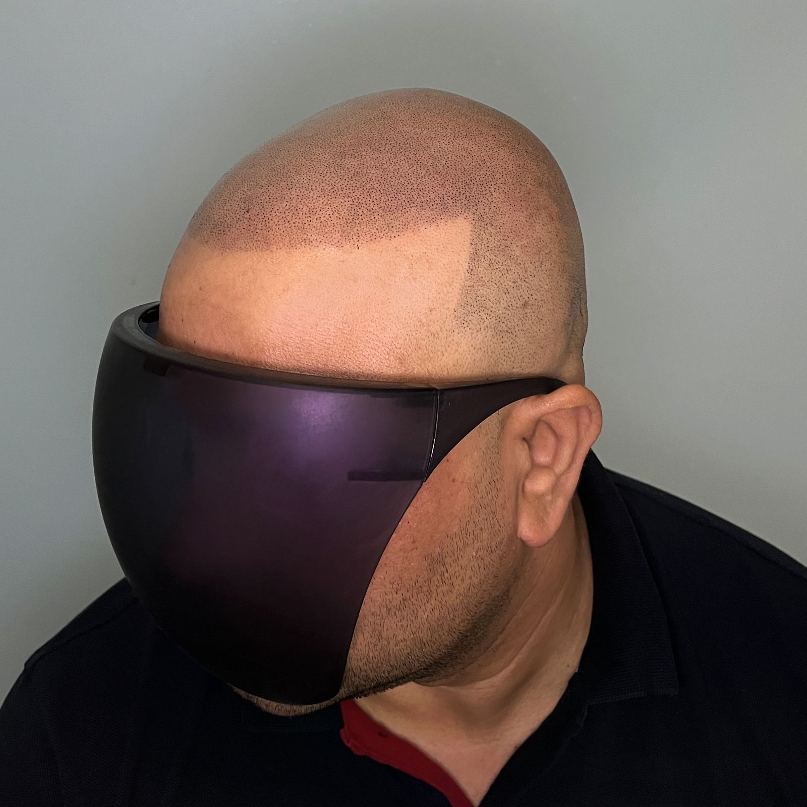 Hands-on scalp micropigmentation training session at Hairline SMP Academy Zirakpur