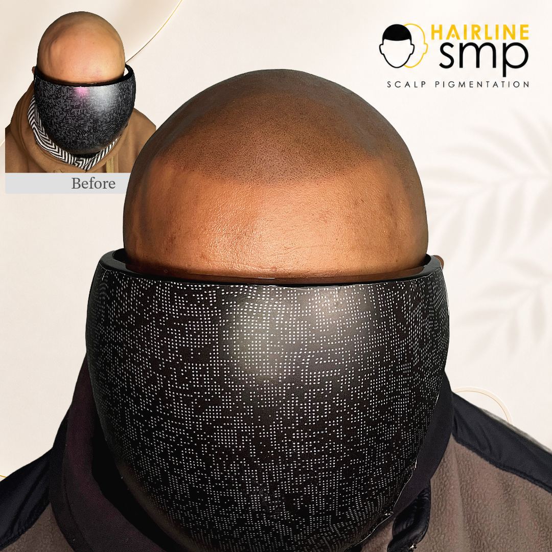 1 — scalp micropigmentation at Hairline SMP Zirakpur